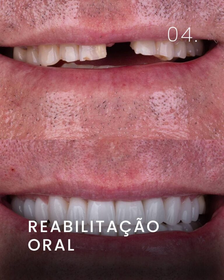 Reabilitação Oral